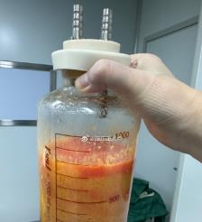 保定水动力吸脂手术要做多久？